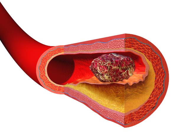 Formación de un coágulo sanguíneo en una placa arterial - Blausen.com staff (2014). WikiJournal of Medicine 1 (2). DOI:10.15347/wjm/2014.010 - Free use under Creative Commons