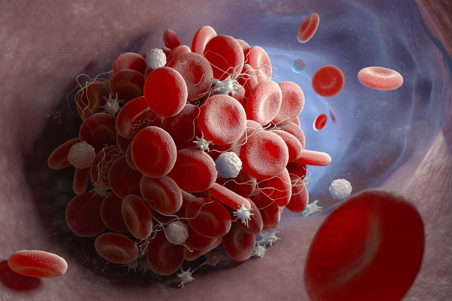 Prevent a Deadly Clot