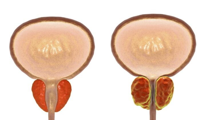 Una próstata normal en comparación con una hiperplasia prostática benigna.